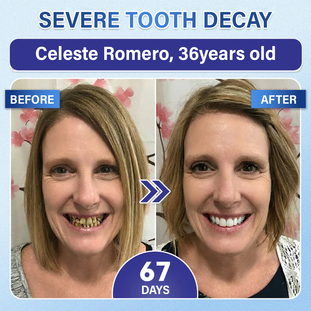 Your Smile🦷SEAGRIL® Tooth & Gum Repair Fast-Dissolving Microneedle Patch✨ (𝟓-𝐢𝐧-𝟏 💎 𝐑𝐞𝐛𝐮𝐢𝐥𝐝 𝐄𝐧𝐚𝐦𝐞𝐥 & 𝐃𝐞𝐧𝐭𝐢𝐧 • 𝐒𝐭𝐫𝐞𝐧𝐠𝐭𝐡𝐞𝐧 𝐆𝐮𝐦𝐬 • 𝐄𝐫𝐚𝐝𝐢𝐜𝐚𝐭𝐞 𝐓𝐚𝐫𝐭𝐚𝐫 & 𝐎𝐝𝐨𝐫 • 𝐖𝐡𝐢𝐭𝐞𝐧𝐢𝐧𝐠 • 𝐒𝐭𝐨𝐩 𝐓𝐨𝐨𝐭𝐡 𝐒𝐞𝐧𝐬𝐢𝐭𝐢𝐯𝐢𝐭𝐲)